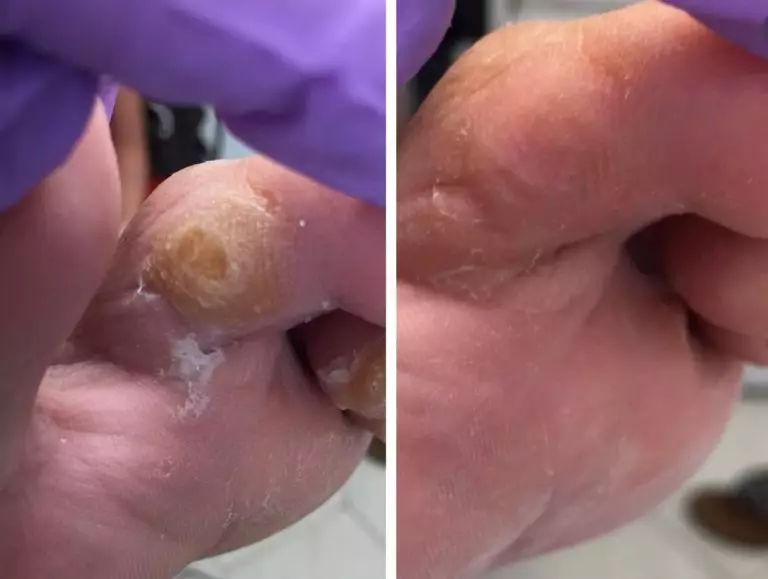 Удаление межпальцевого натоптыша