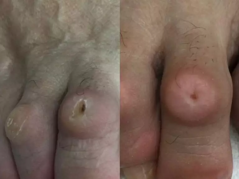 Удаление пальцевой шпоры