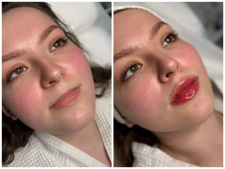 Контурная пластика губ