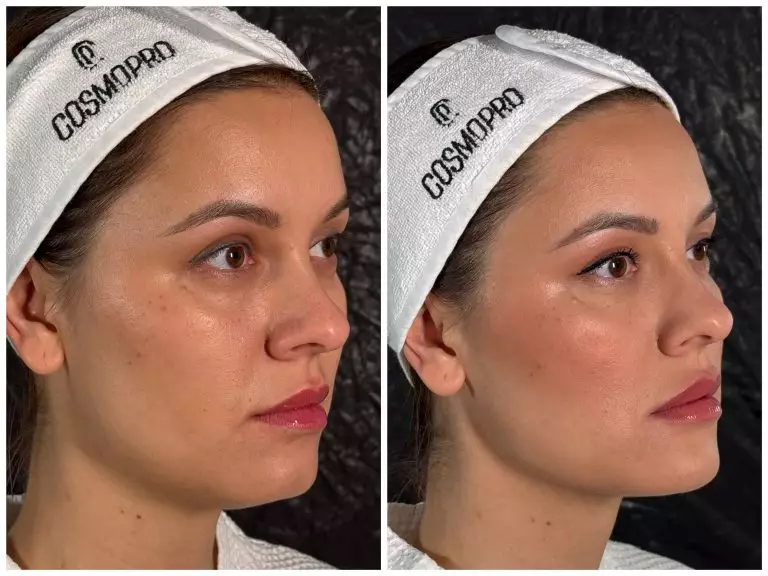 Контурная пластика подбородка