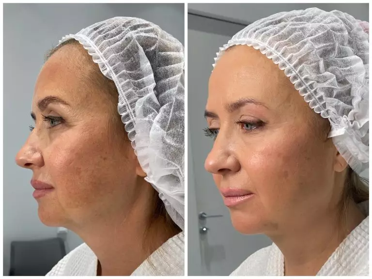 SMAS-лифтинг Ultraformer MPT