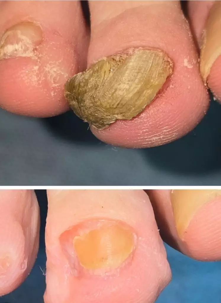 Онихогрифоз ногтевой пластины