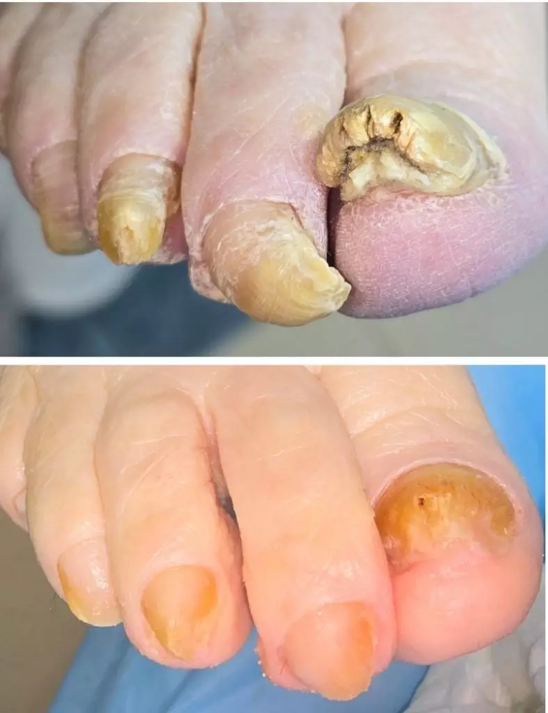 Грибковое поражение ногтевых пластин