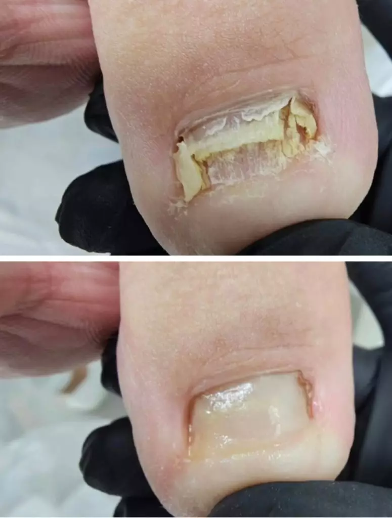 Протезирование ногтевой пластины