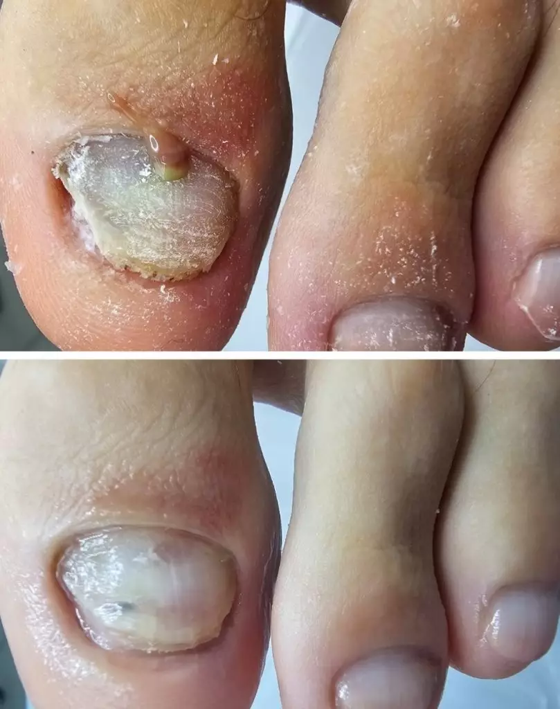 Подногтевой панриций