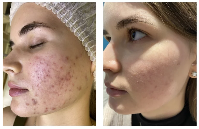 Сухая чистка лица + Плазмотерапия