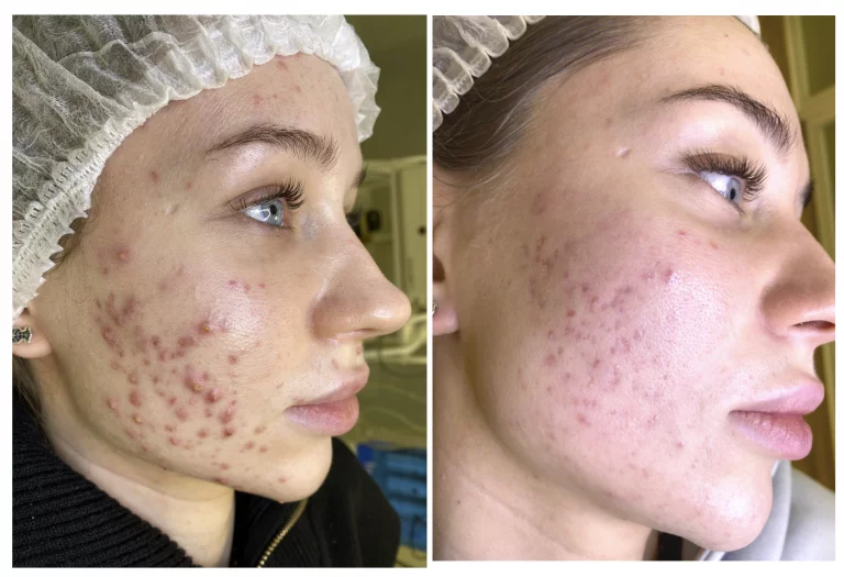 Сухая чистка лица + Плазмолифтинг