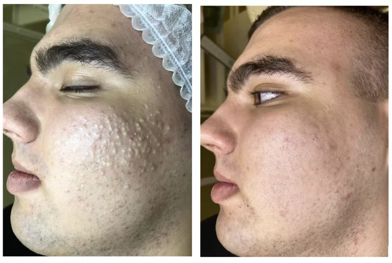 Сухая чистка лица