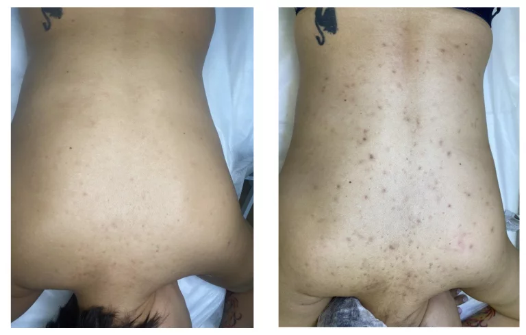 Лазерное лечение акне