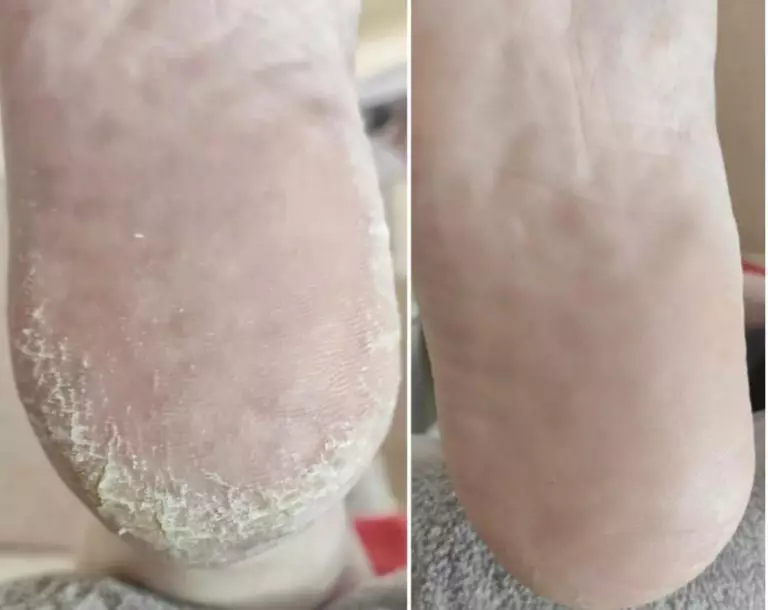 Лечение гиперкератоза стопы