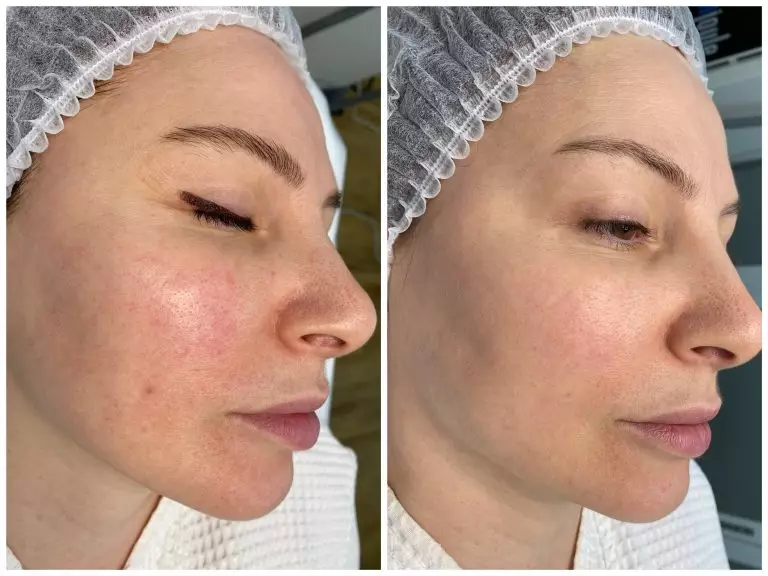 Фотоомоложение кожи BBL