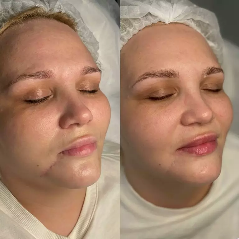 Контурная пластика губ