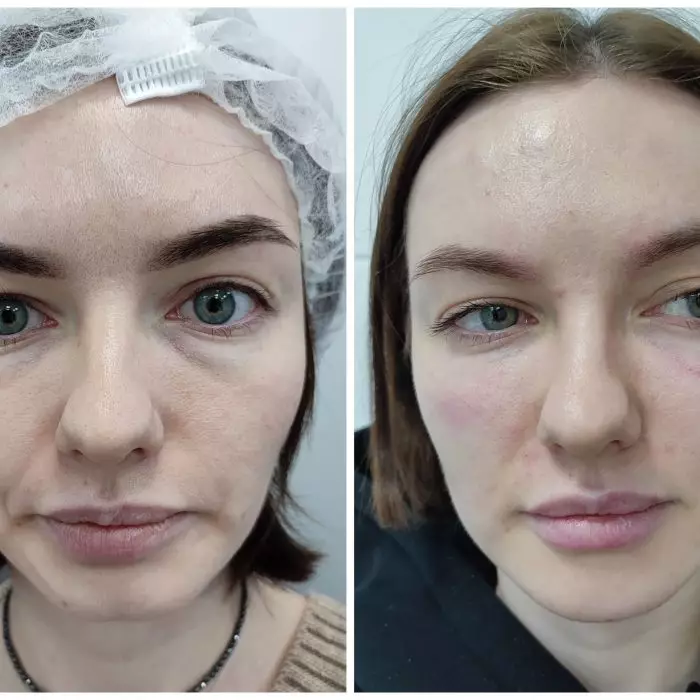 Контурная пластика FullFace и комплексное омоложение