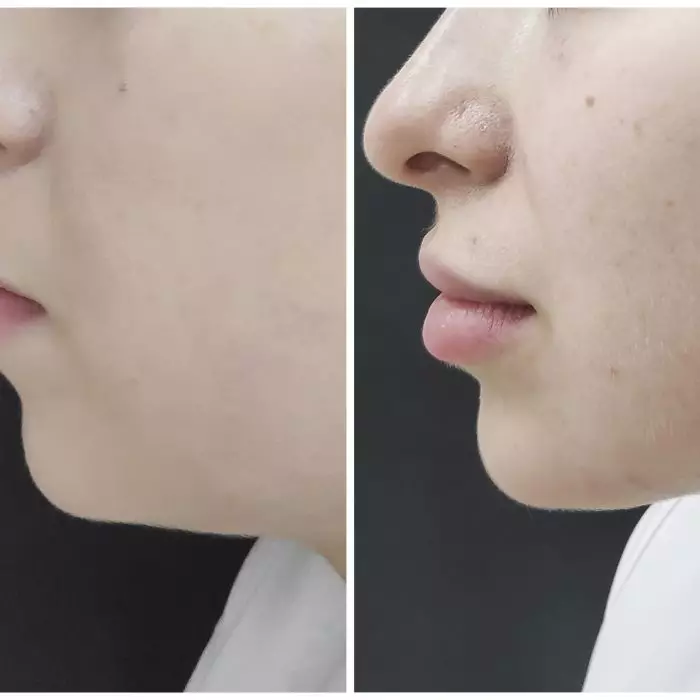 Комплексный лифтинг овала лица