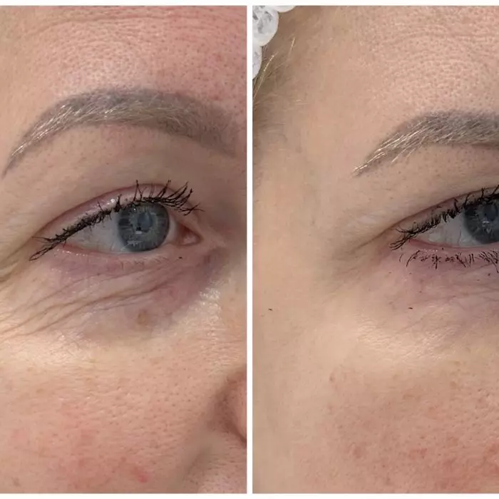 Омоложение кожи вокруг глаз