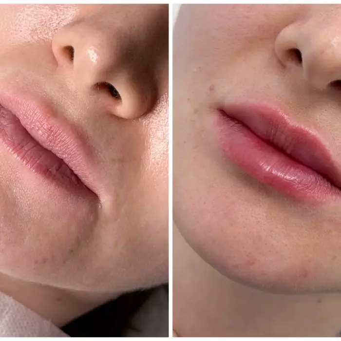 Контурная пластика губ