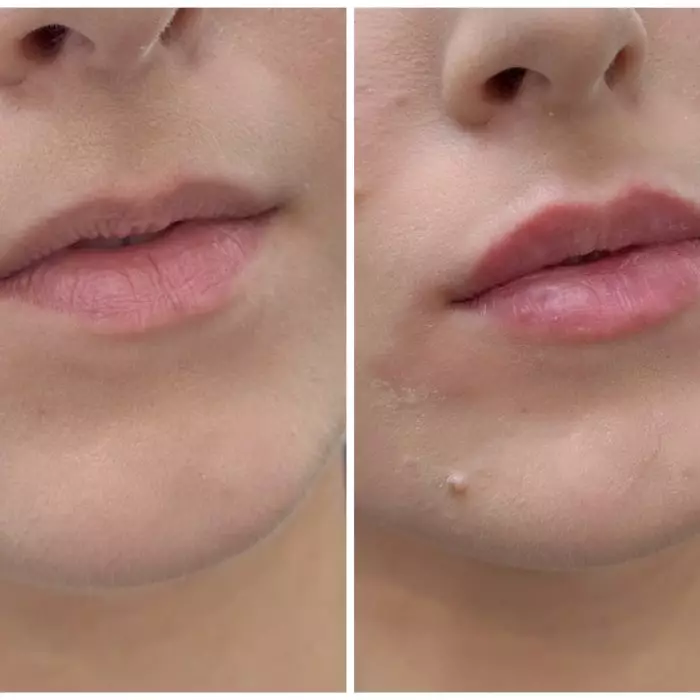 Контурная пластика губ