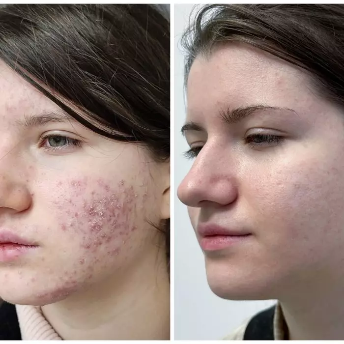 Комплексное лечение акне