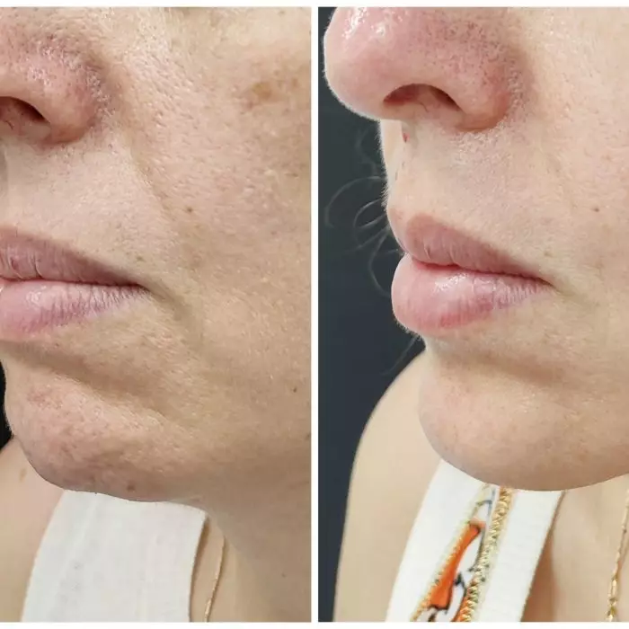 Ботулинотерапия овала лица и подбородка