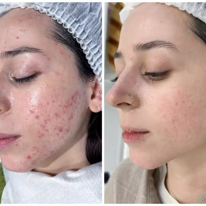 Комплексное лечение акне