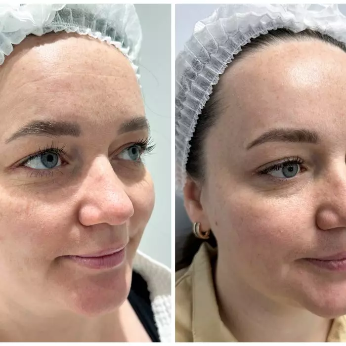 Комплексная коррекция морщин (Только лоб)