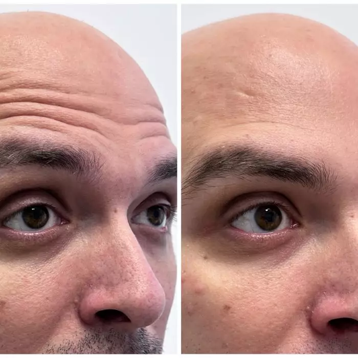 Коррекция морщин (Только лоб)