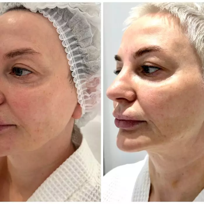 Нитевой лифтинг овала лица (Овал лица)