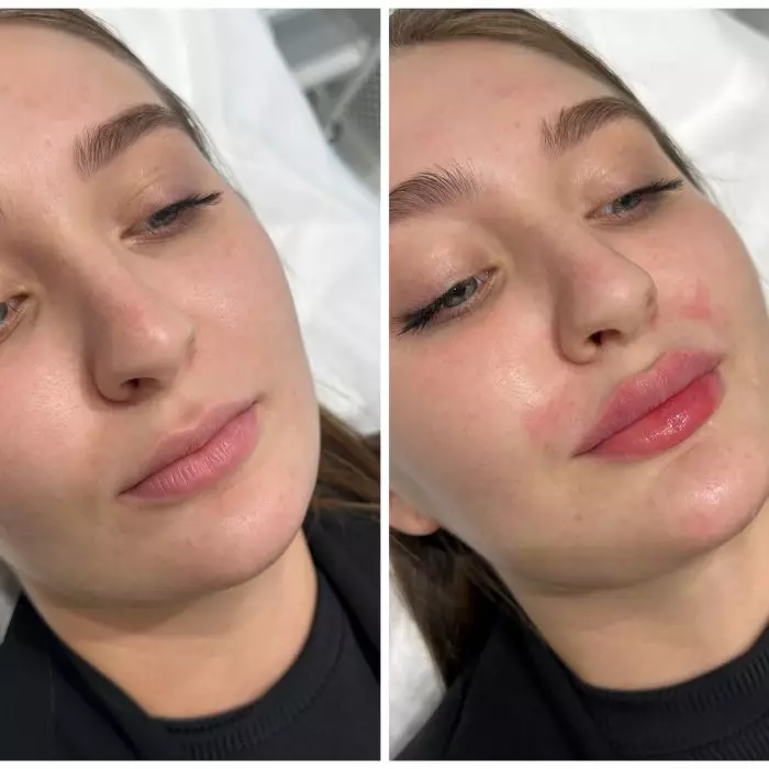 Контурная пластика губ (Только губы)