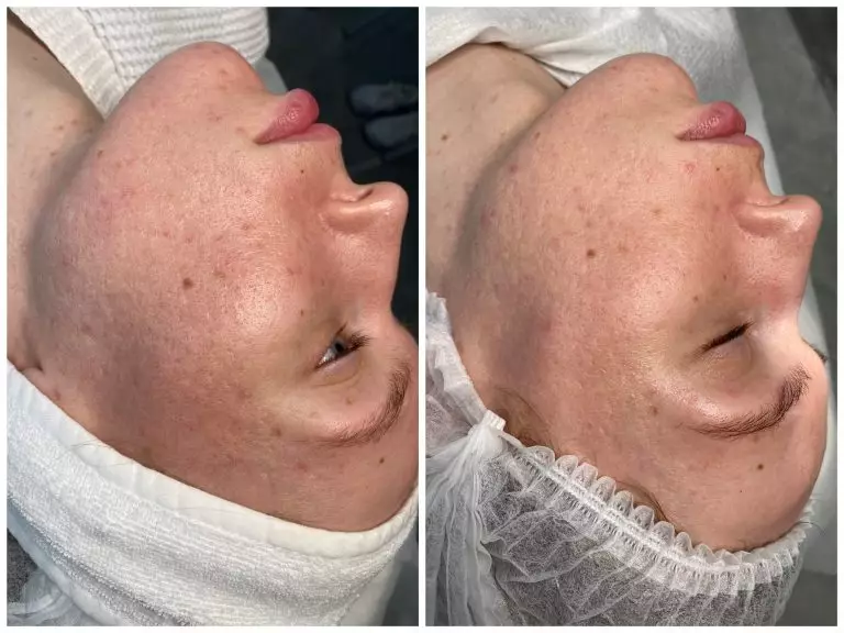 Игольчатый RF-лифтинг GENIUS