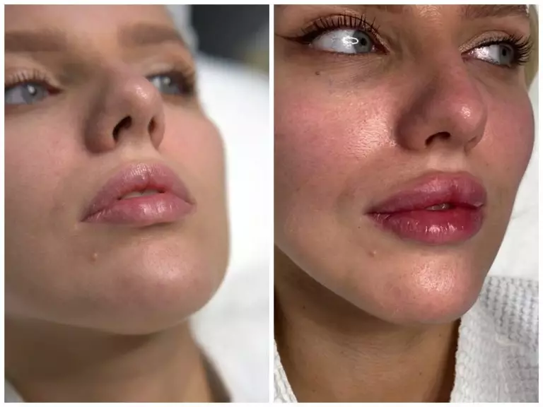 Контурная пластика губ