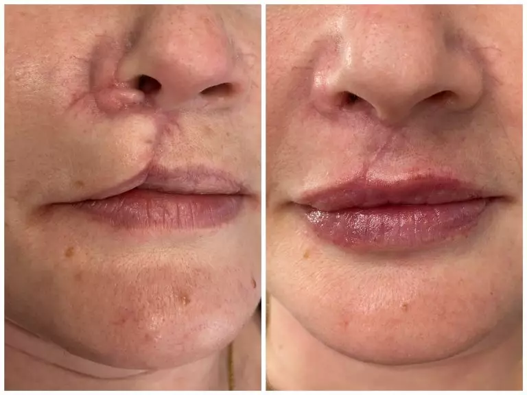 Комплексное устранение рубца