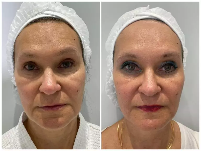 Комплексное омоложение. Игольчатый RF-лифтинг, коллагенотерапия