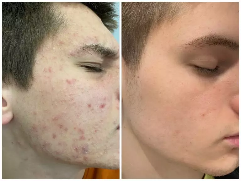 Комплексное лечение акне