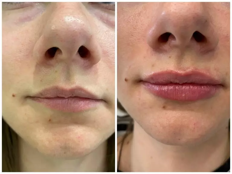 Контурная пластика губ