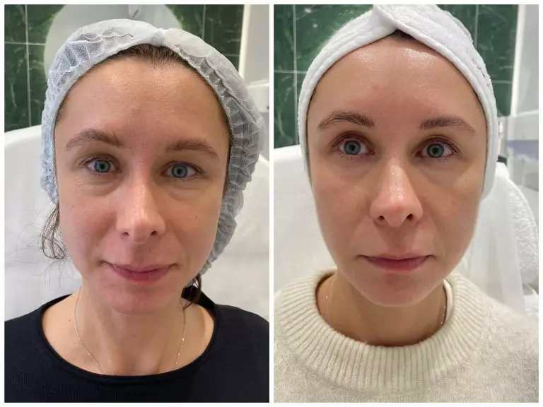 Комплексное омоложение. Игольчатый RF-лифтинг, ботулинотерапия