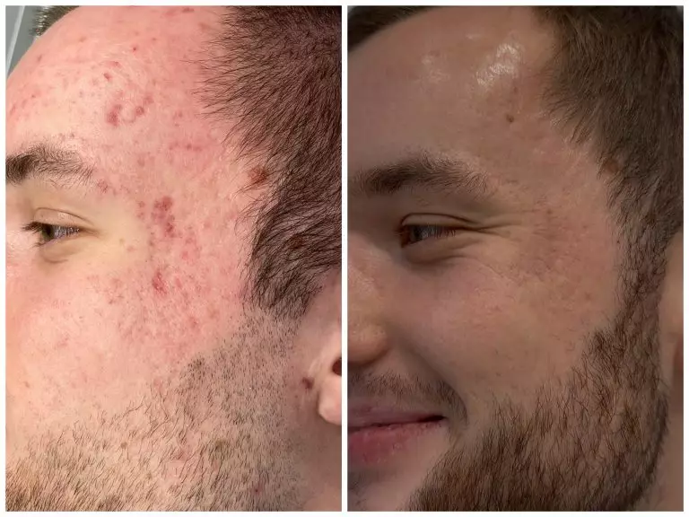 Комплексное лечение акне