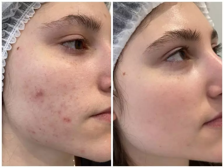 Комплексное лечение акне