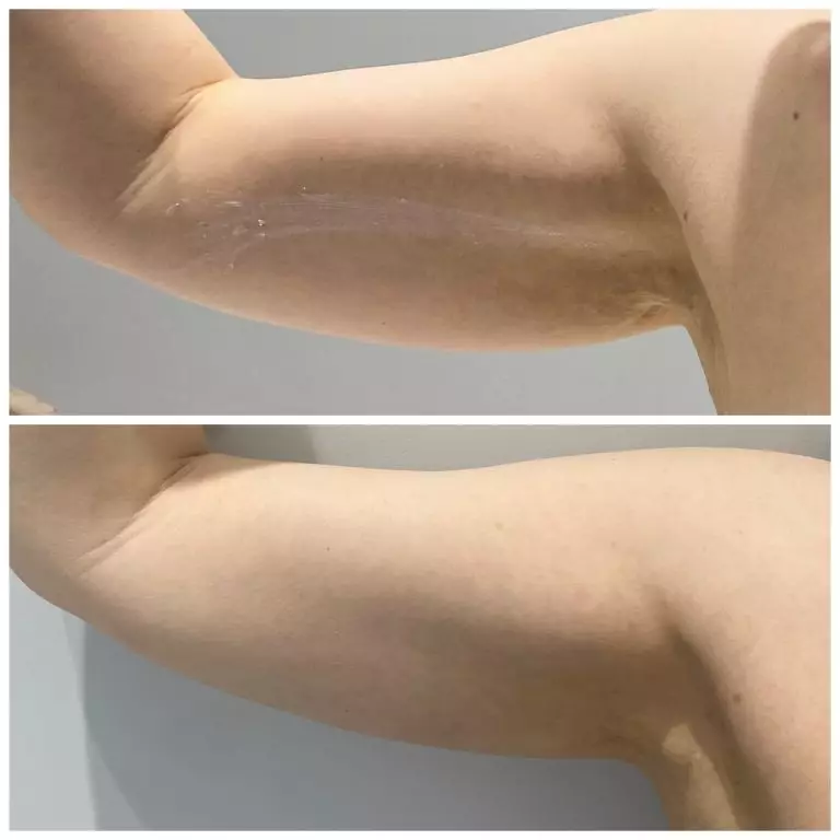 Эндолифтинг (безоперационная подтяжка) внутренней части плеча