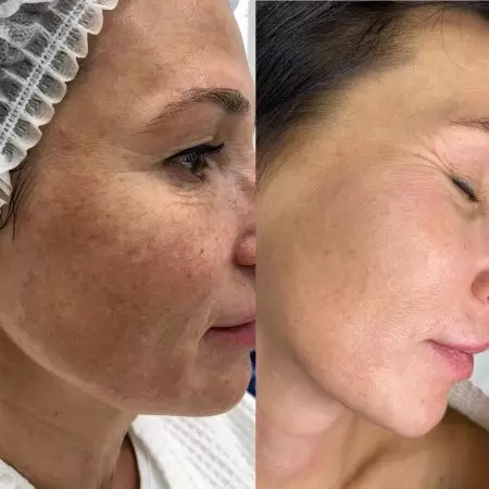 Лечение пигментации