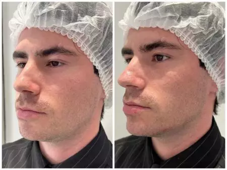 Коррекция нижней трети лица, врач Колмаков К.С.