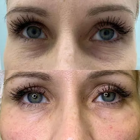 Коррекция носослезной борозды