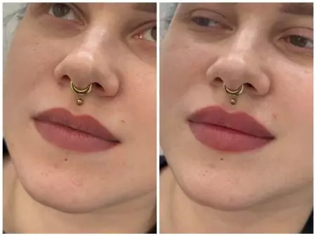 Контурная пластика губ, врач Колмаков К.С.