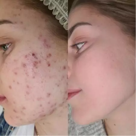 Комплексное лечение акне