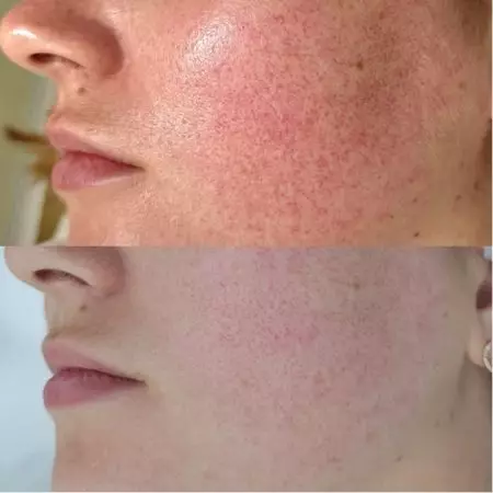 Фотоомоложение BBL