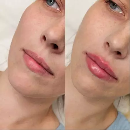 Контурная пластика губ