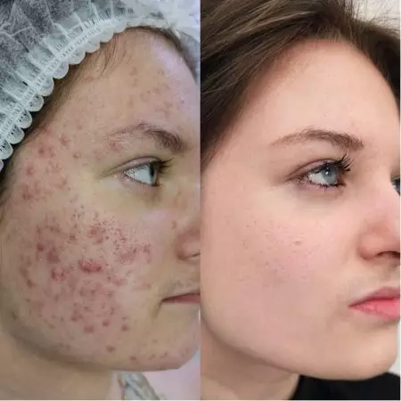 Комплексное лечение акне