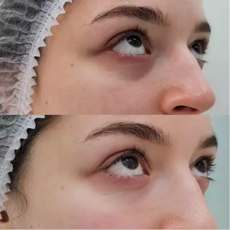 Коррекция носослезной борозды