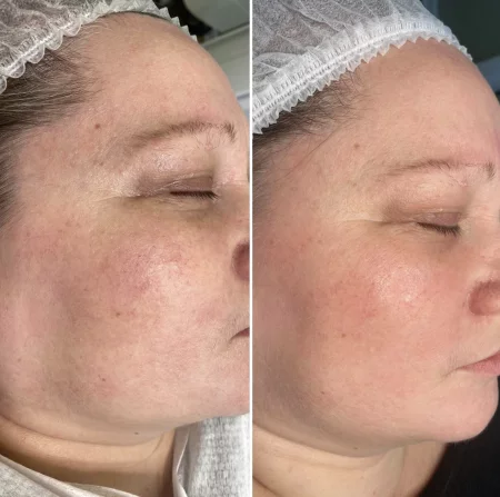 Лечение сосудистых паталогий